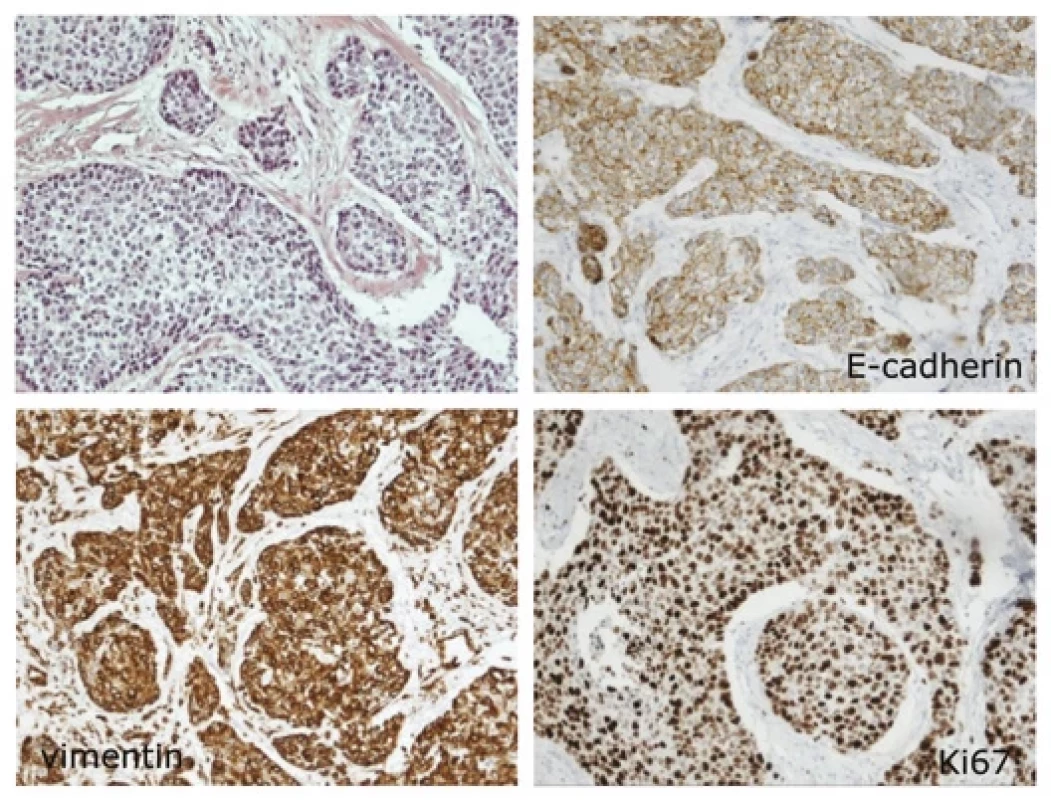 An example of triple negative breast cancer.