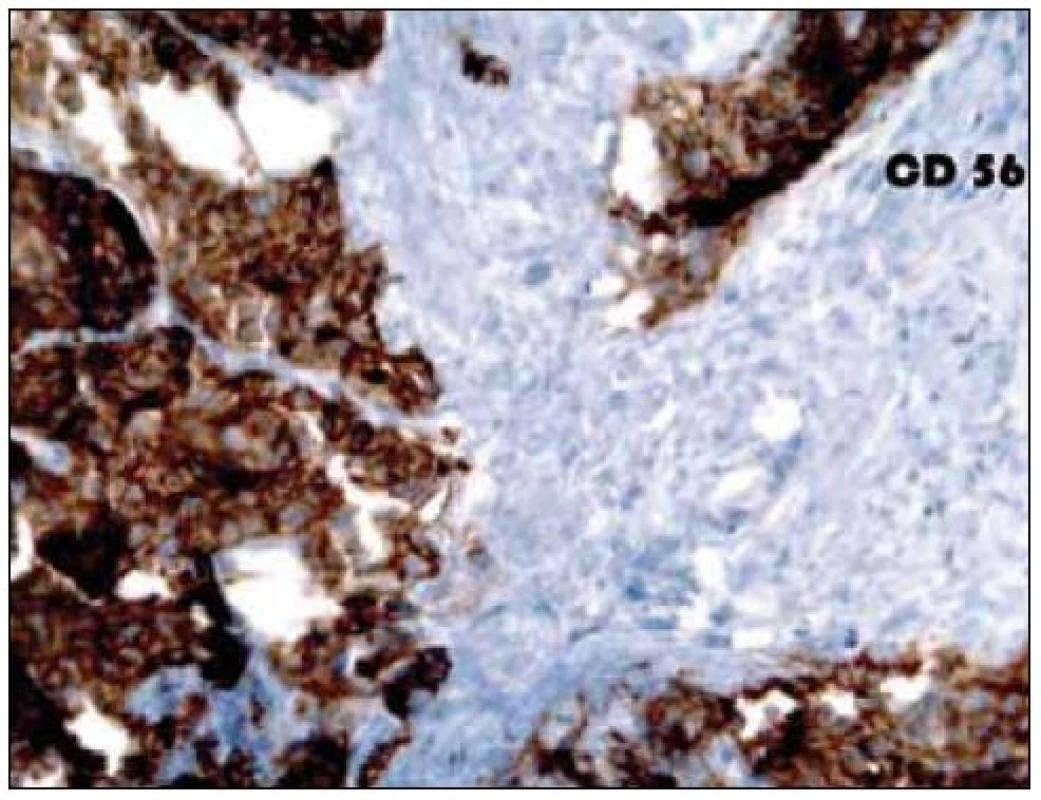 Imunohistochemické vyšetření jaterního parenchymu, pozitivita antigenu CD 56.