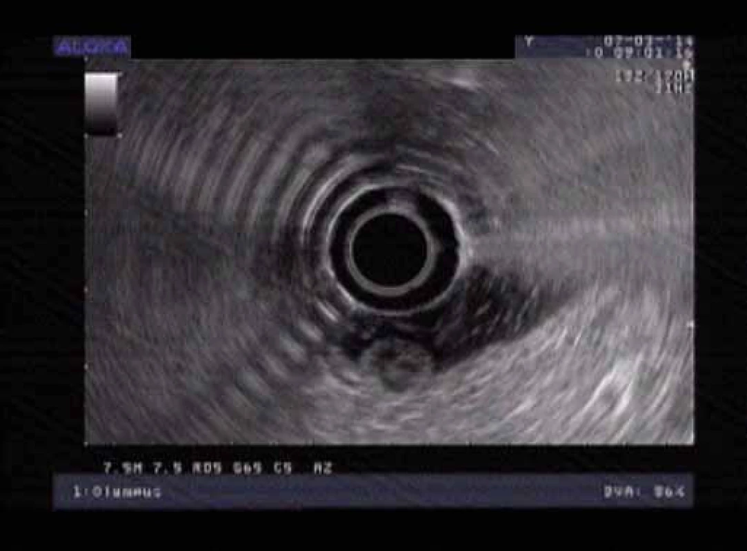 Endosonografie duodena.
Fig. 3. Endosonography of the duodenum.