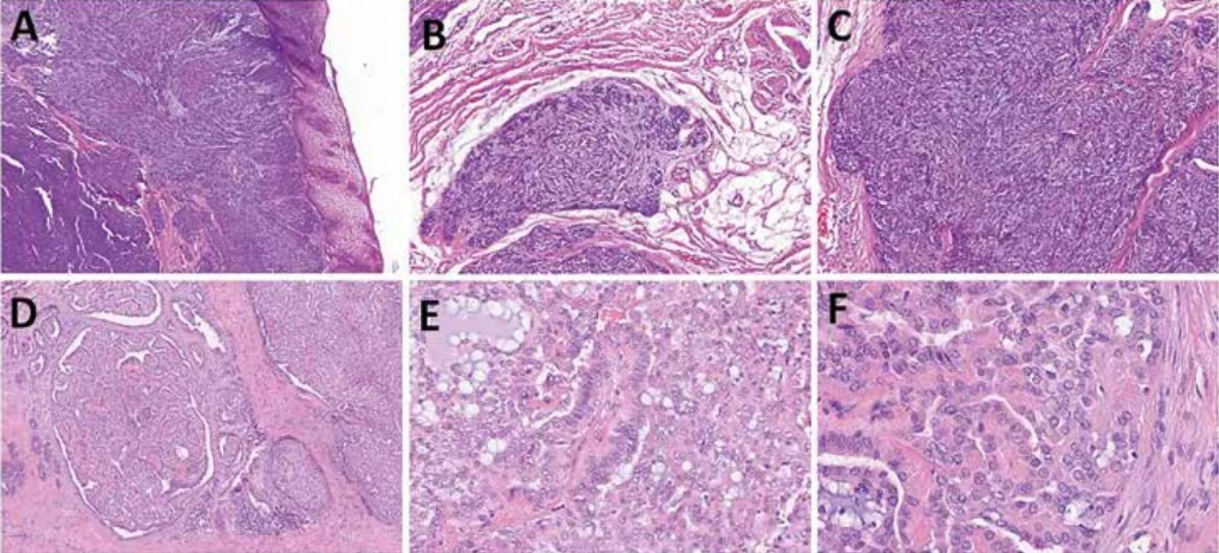 Polymorfní adenokarcinom (PAC) (A-C) a kribriformní adenokarcinom (CASG) (D-F). PAC je maligní epiteliální nádor charakterizovaný cytologickou uniformitou, morfologickou rozmanitostí a infiltrativním růstem, zde sestávají z vřetenitých buněk (A-C). CASG je charakterizován multinodulární růstovou strukturou s převažující solidní, kribriformní a mikrocystickou architekturou a opticky čirými jádry nádorových buněk (F). Lze pozorovat glomeruloidní a papilární struktury (D-E).
