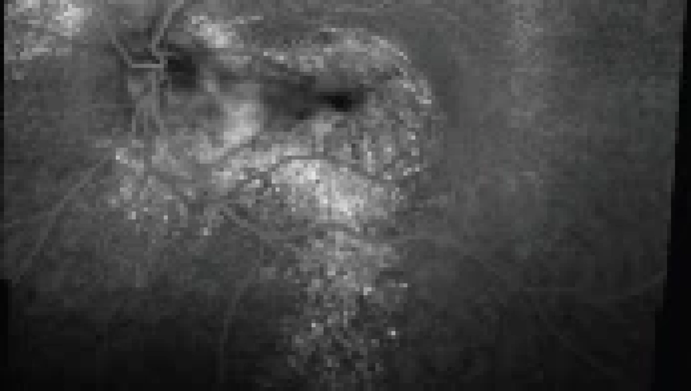 Fluorescenční angiografie 54letého pacienta s chronickou formou centrální serózní chorioretinopatie (Heidelberg Spectralis, Myslík Manethová):