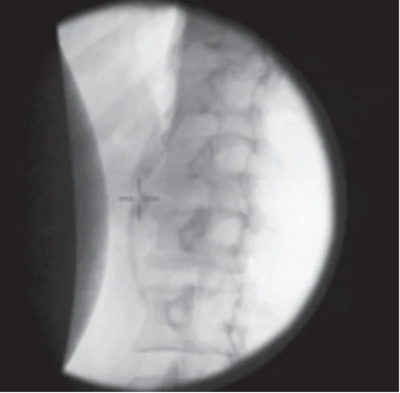 Skiaskopické zobrazení pankreatikolitiázy před ESWL. Fig. 2. Fluoroscopic image of pancreatic lithiasis prior to ESWL.