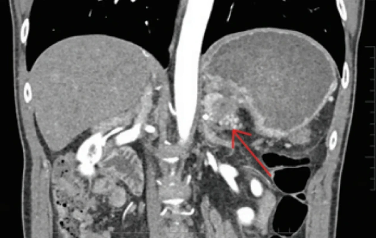CT nález tumoru chvosta pankreasu v koronárnej rovine, arteriálna fáza (tumor vyznačený červenou šípkou). Fig. 1. CT finding of a tumor in the tail of the pancreas in the coronal plane, arterial phase (tumor indicated by a red arrow).