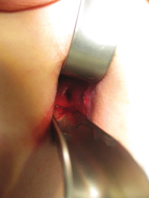 Bodná rána rekta vel. 1 cm s lacerovanými okraji
Fig. 5: Stab wound of the rectum, size 1cm with lacerated edges
