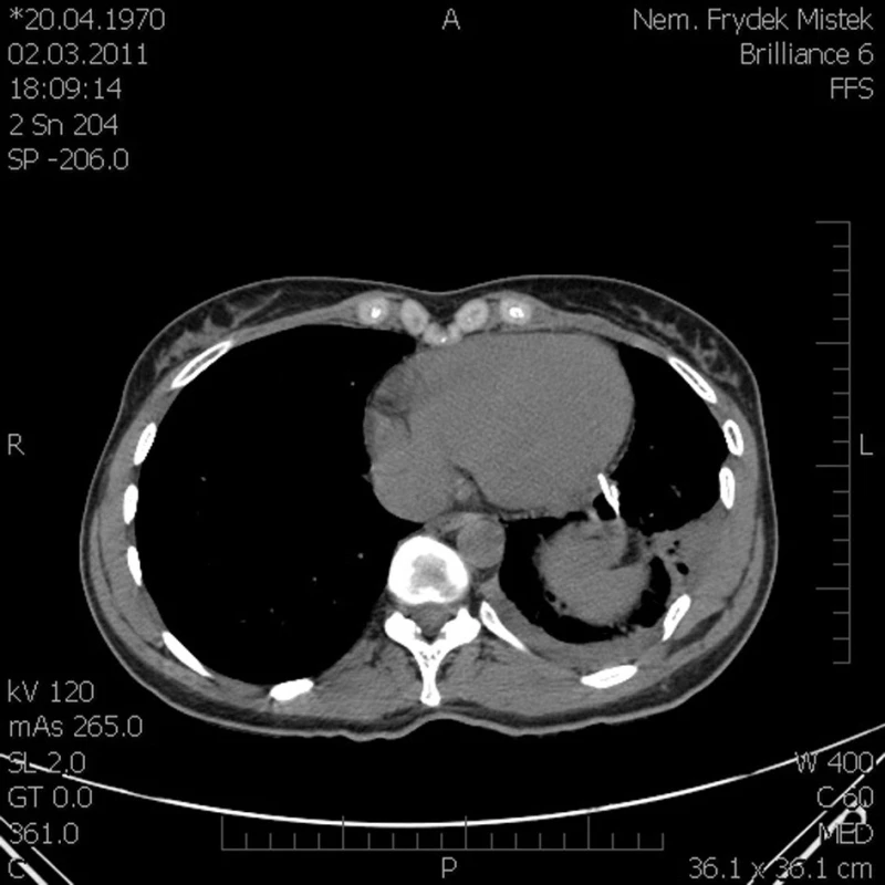 CT sken konec úlomku žebra zobrazený u hrotu srdečního, drobný hemoperikard, kontuze levé plíce
Fig. 2. CT scan – the end of the rib fragment is located near the heart tip, minor haemopericardium, left lung contusion