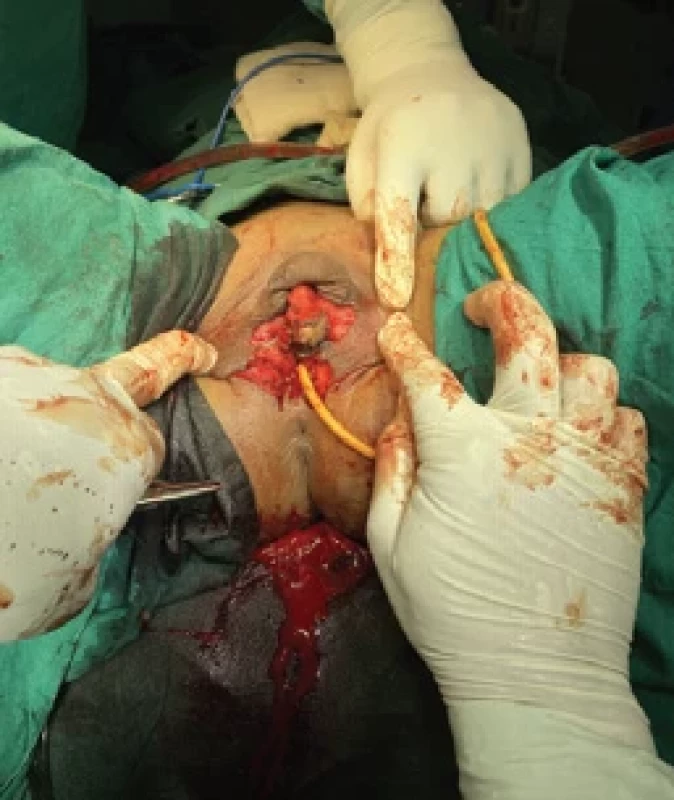 b Intraoperative picture of the same case of congenital adrenal hyperplasia with ambiguous genitalia.