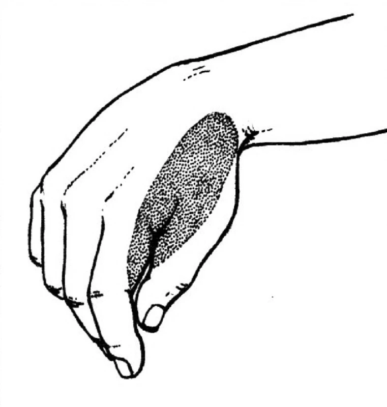 Léze n. radialis na paži.
Paréza radiální i dorzální skupiny svalů předloktí – „dropping hand and dropping fingers“, ruka i prsty
přepadají. Poruchy čití jsou v autonomní kožní zóně.