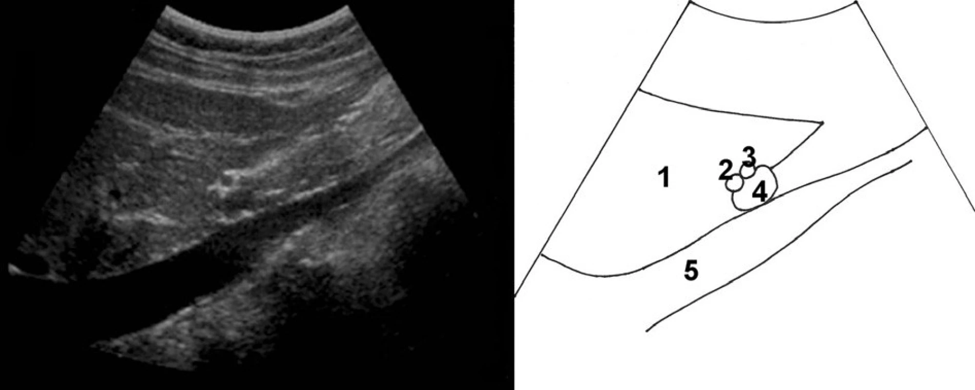 Zobrazení lig. hepatoduodenale; 1 – jaterní parenchym, 2 – ductus choledochus, 3 – a. hepatica propria, 4 – vena portae, 5 – vena cava inferior
