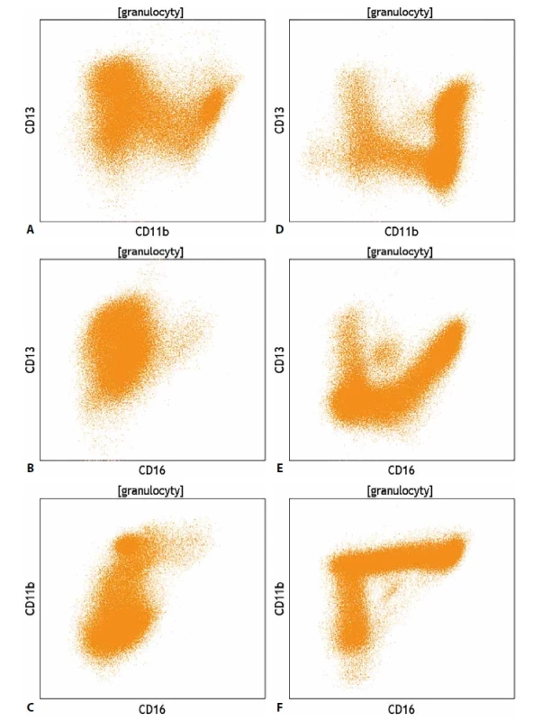 (A,B,C) Srovnání exprese znaků CD11b, CD13 a CD16 na vyzrávajících granulocytech u pacienta s myelodysplastickým syndromem a (D,E,F) u pacienta se zdravou krvetvorbou.