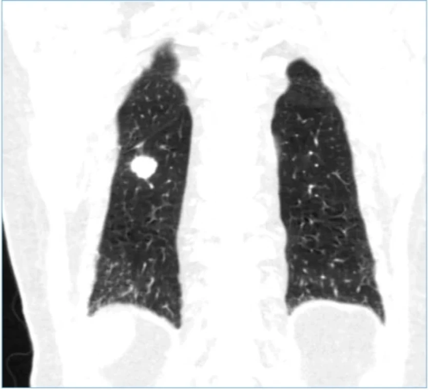Metastáza karcinomu močového měchýře v pravé plíci. Zdroj: Archiv Krajské nemocnice Liberec. Fig. 3. Metastasis of bladder cancer in the right lung. Source: Regional Hospital Liberec archive. 