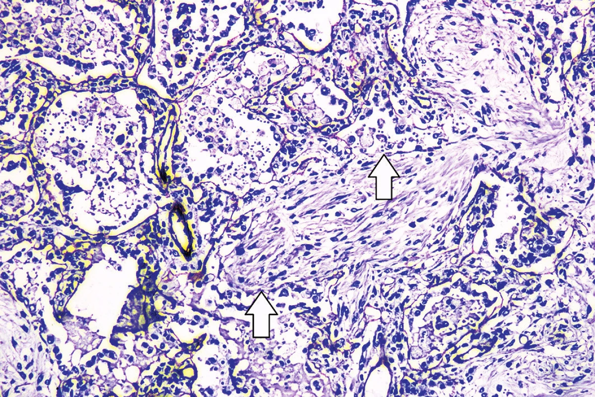 Imunohistochemický dôkaz výpadku laminínu (šípky) v mieste organizujúcej sa pneumónie (imunohistochémia anti-laminin, zväčšenie 100x).