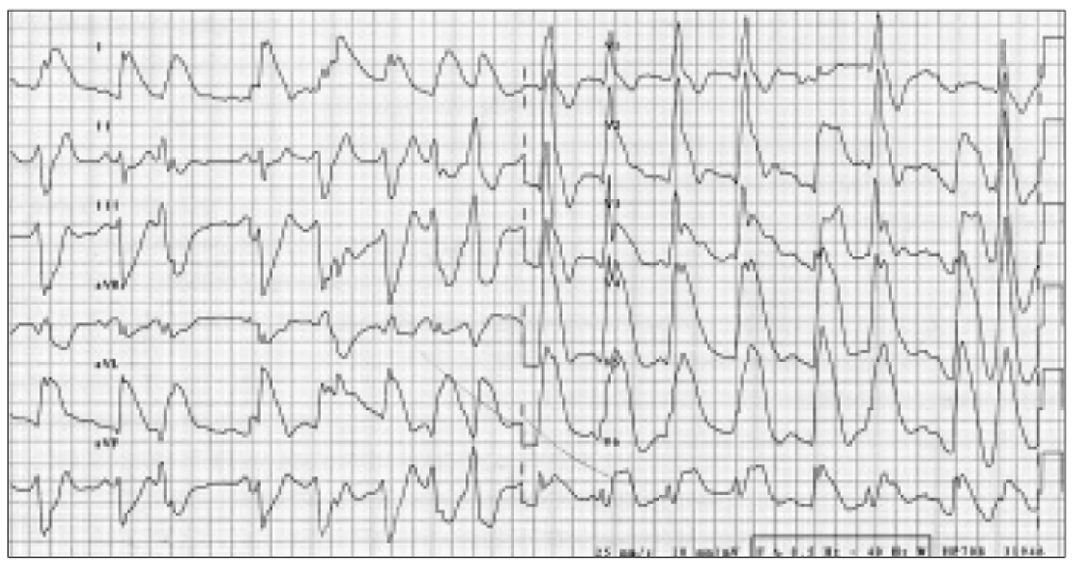 Elevace ST úseků I, aVL, V<sub>2–6</sub> na vstupním EKG.