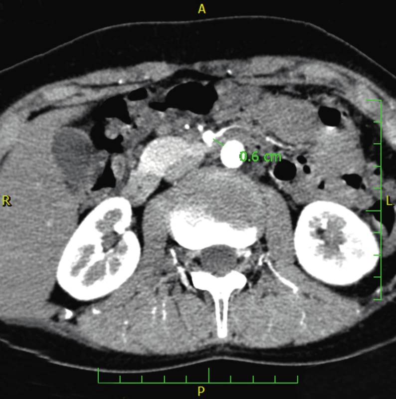 CT angiografie ukazující nápadné snížení vzdálenosti mezi aortou a horní mezenteriální arterií asi 6 mm u pacienta 1. (Obrazový materiál Oddělení radiologie Nemocnice Karviná, MUDr. Kupková).
Fig. 3. CT angiography showing the reduction of aortomesenteric distance measuring about 6 mm (case report one).