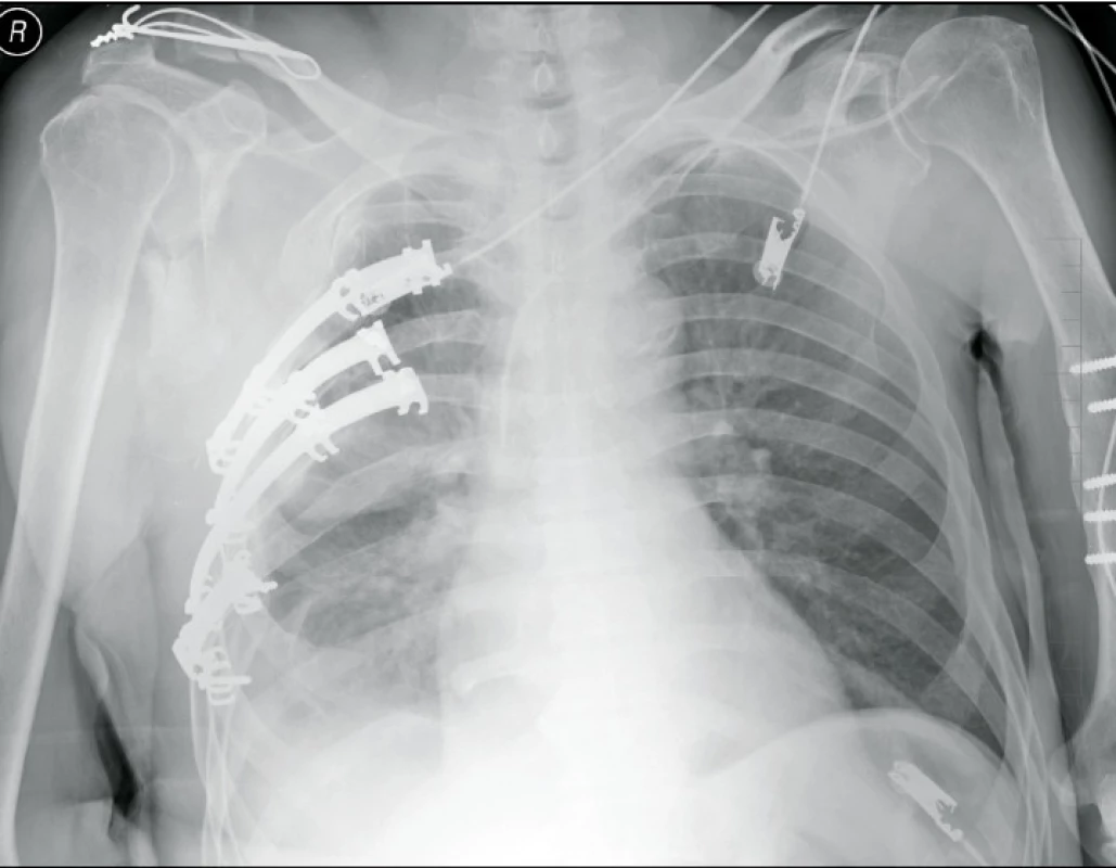 Osteosyntéza čtyř žeber u blokové zlomeniny žeber vpravo pomocí Judetových dlah firmy Medin a.s. (pooperační rtg snímek hrudníku)