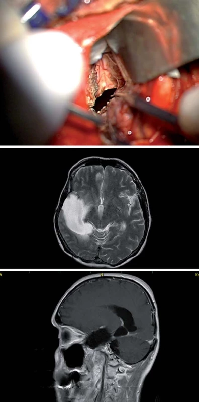 Zadní interhemisferický přístup.
Fig. 9. Posterior interhemispheric approach.
