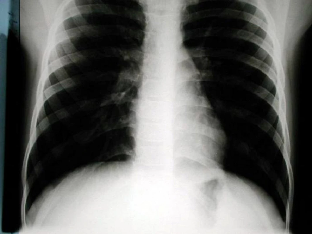 Snímek 9 měsíců po sutuře ruptury bránice vlevo