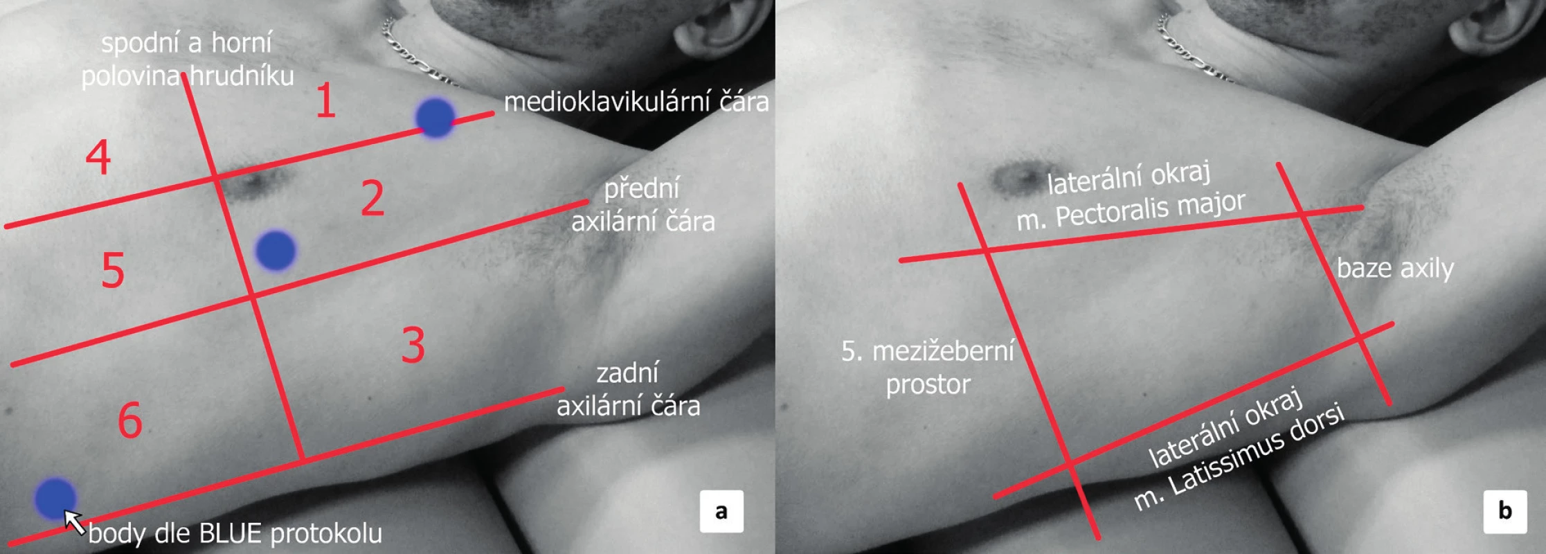 Hrudnik UZ projekce