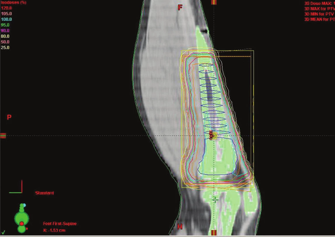 Technika 3D konformní RT u sarkomu tibie dolní končetiny
Fig. 1. Conformal RT 3D technique in tibial sarcoma