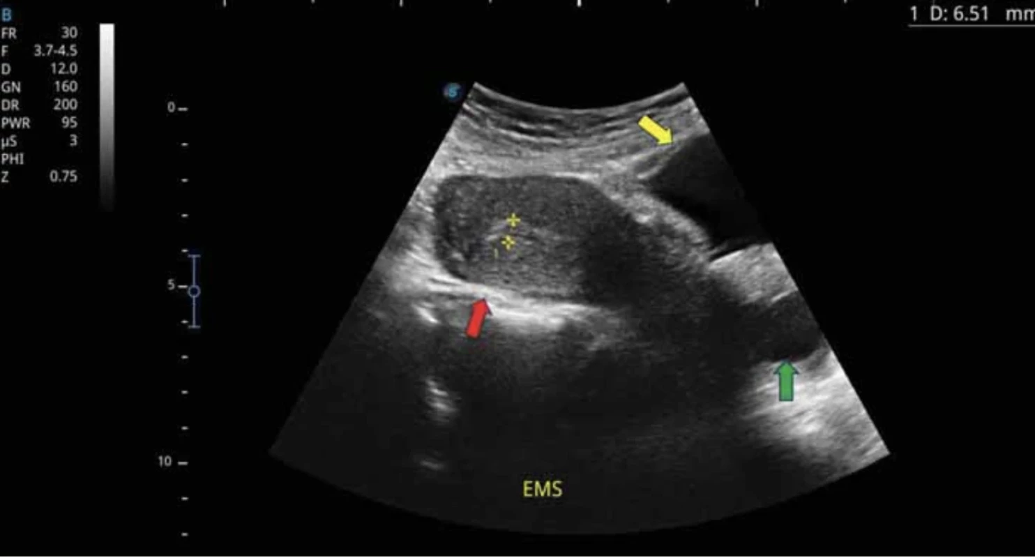 Red arrow – uterus, yellow arrow – urinary bladder, green arrow – vagina dilated with fluid – urine (published with the patient's permission).
// Červená šipka – děloha, žlutá šipka – močový měchýř, zelená šipka – pochva dilatovaná tekutinou – močí (publikováno se svolením pacientky).