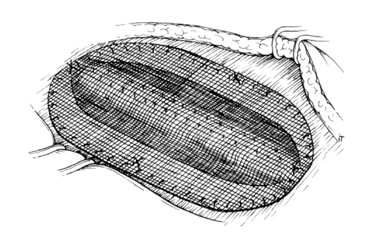 Stav po onlay našití prostetického materiálu – sieťky
Fig. 3. On-lay application of the prosthesis ( mesh)