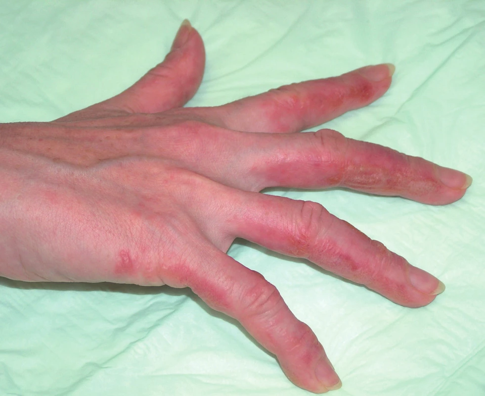 Fotoalergická kontaktní dermatitida (ketoprofen).
