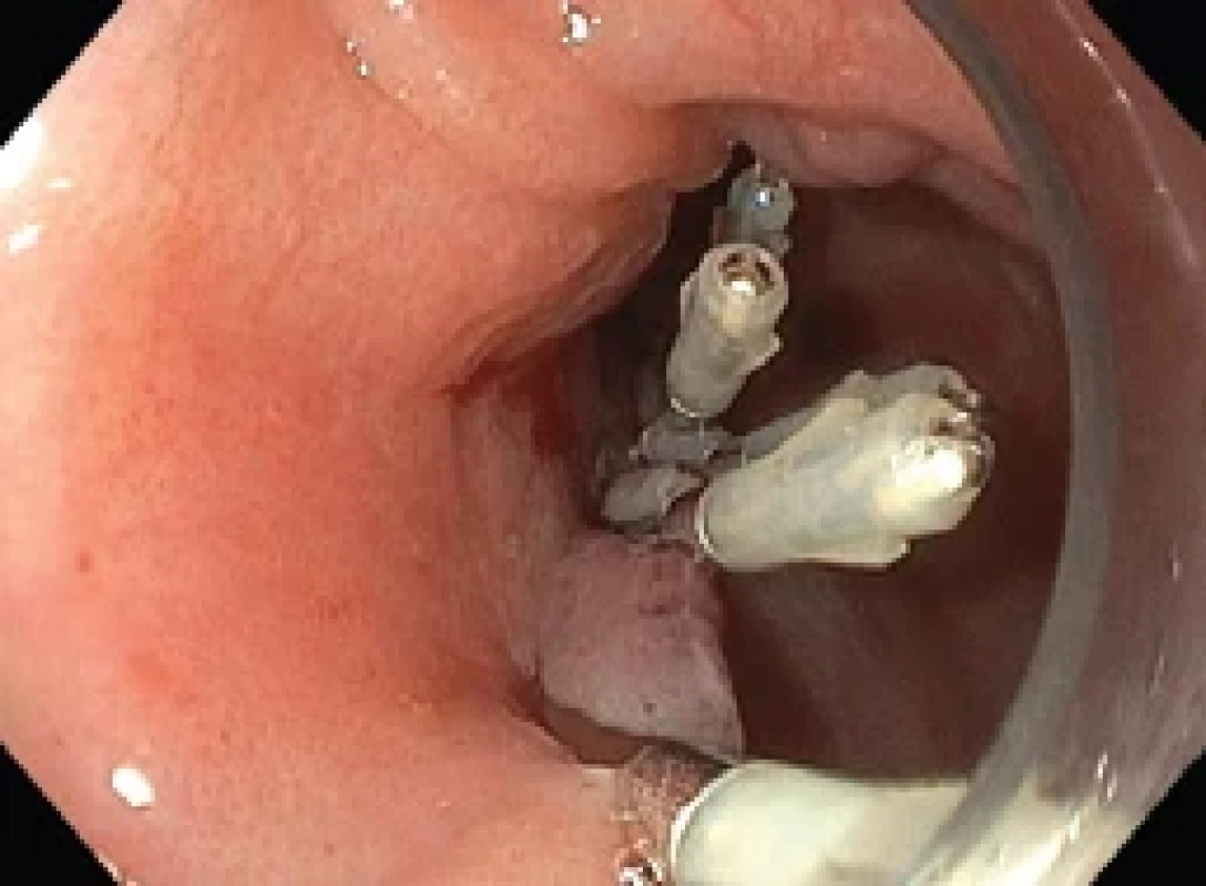 Closure of mucosal incision by endoscopic clips. Obr. 􀍺. Uzavření slizničního řezu endoskopickými klipy.