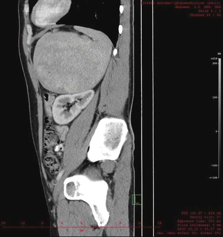 CT sagitální řez zachycuje kulovitou expanzi v těsném vztahu k levé ledvině, bez možnosti diferencovat nadledvinu
Fig. 4: A sagittal CT scan shows a round expansion in close proximity to the left kidney. The suprarenal gland could not be differentiated