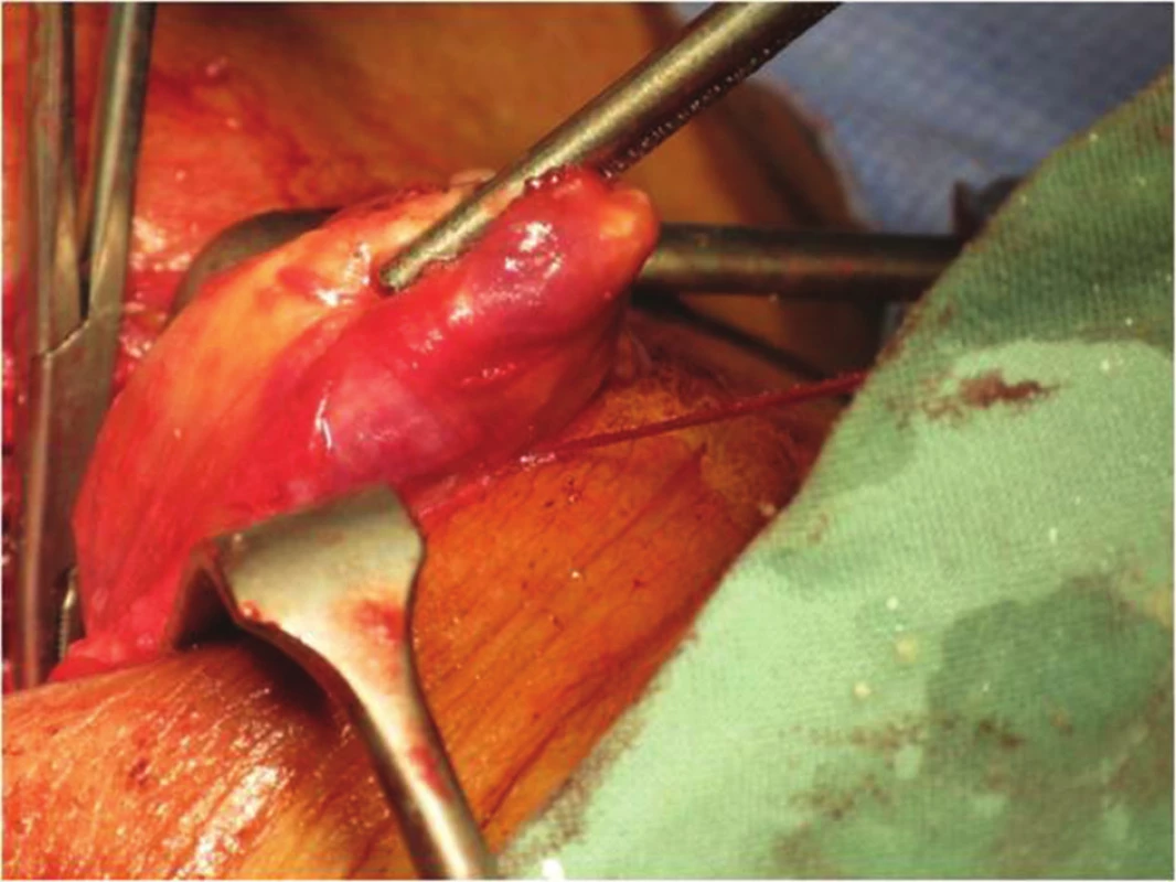 Příštítný nádor
Fig. 3: Parathyroid Tumour