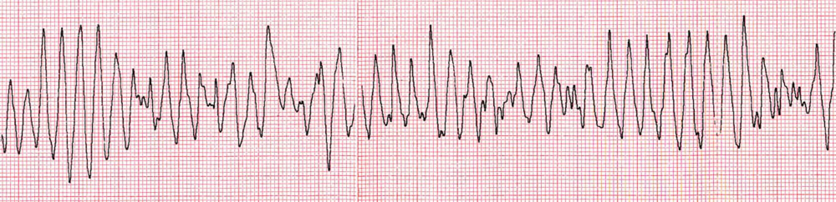 Polymorfní komorová tachykardie degenerující do fibrilace komor – záznam při resuscitaci.