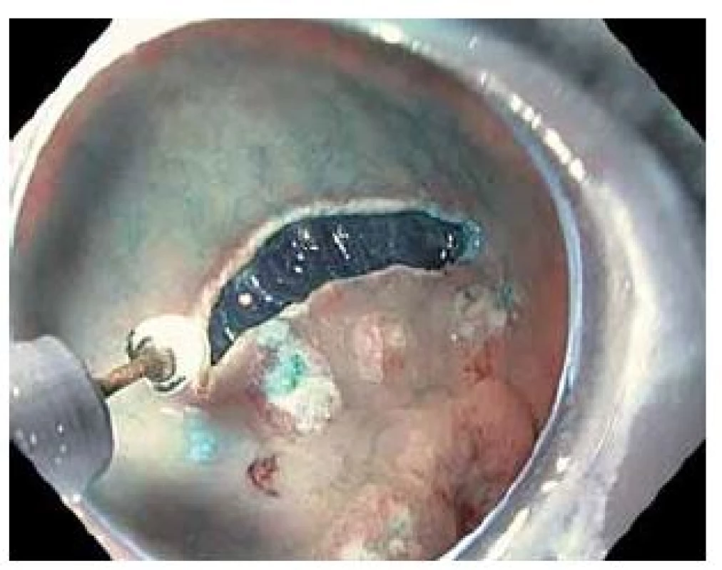 Cirkulární incize nástrojem IT-knife2.
Fig. 2. Circumferential incision made using IT-knife 2.