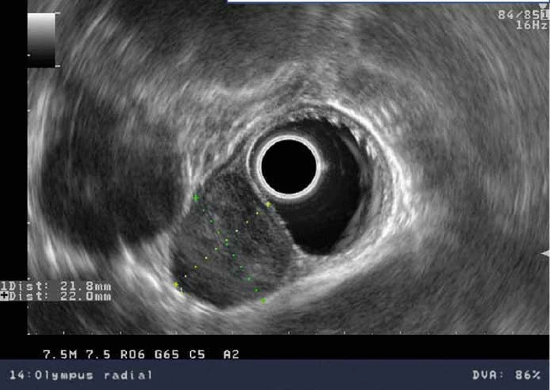 EUS obraz dobře ohraničeného hypoechogenního subepiteliálního nádoru jícnu vycházejícího z m. propria, v sousedství nádoru aorta.
Fig. 1. EUS image of a hypoechoic subepithelial tumour with clear margins originating from the middle layer, with the aorta next to the tumour.