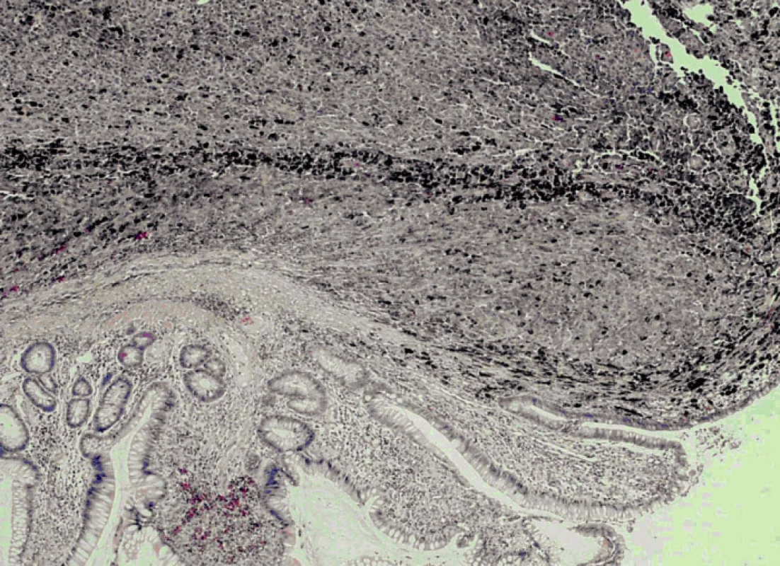 Infiltrace sliznice tenkého střeva maligním melanomem (HE, 80x)
Fig. 6. The infiltration of mucosis of the small intestine with melanoma malignum (HE, 80x)