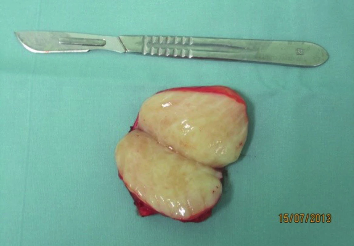 Resekát ganglioneuromu
Fig. 5: Resected ganglioneuroma