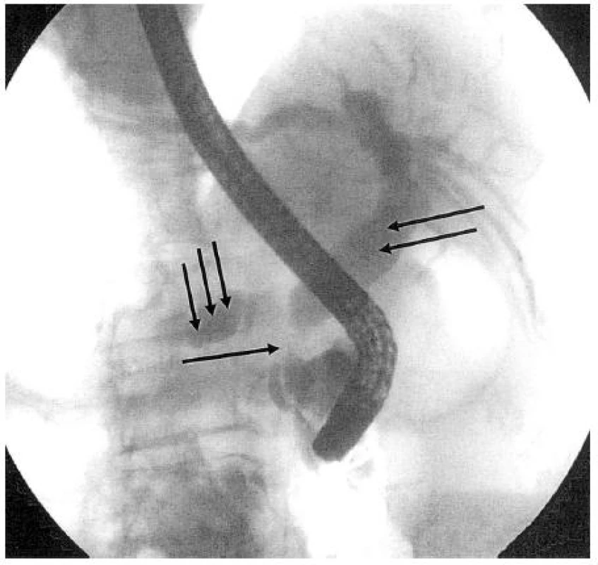 ERCP nález nádorové stenózy terminálního úseku choledochu a hlavního pankreatického vývodu při karcinomu hlavy pankreatu (↑), suprastenotická dilatace žlučovodu (↑↑) a hlavního pankreatického vývodu (↑↑↑): „double duct sign“