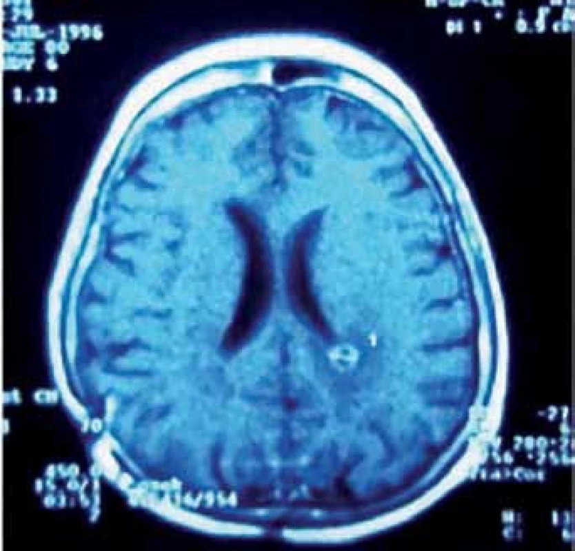 Pineoblastom. 
Obr. 3a) MR v transverzální rovině řezu. Obr. 3b) MR v sagitální rovině řezu. Obr. 3c) Peroperační pohled na tumor. Obr. 3d) Pohled do III. komory po exstirpaci nádoru. Obr. 3e) Pooperační MR kontrola. Obr. 3f) Implantační metastáza v levé postranní komoře detekovaná s odstupem jednoho roku po operaci.