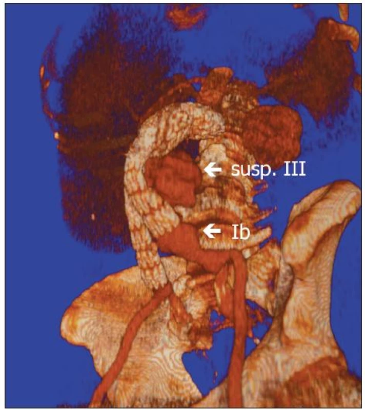 CTA rekonstrukce ze spádové nemocnice. Šipky označují endoleaky Ib a suspektní III
Fig. 1. A CTA reconstruction done in district hospitál. Arrows show endoleaks type I band suspicious III