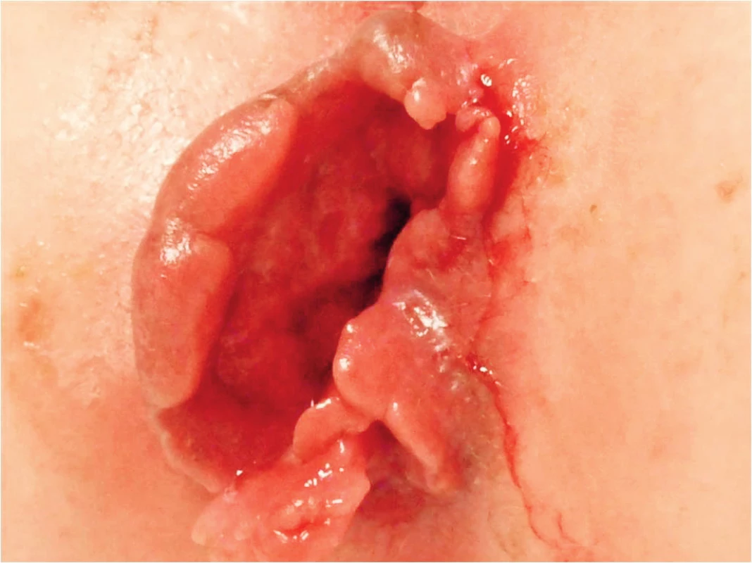 Perianálny nález Crohnovej choroby u 9-ročnej pacientky.
Fig. 2. Perianal finding of Crohn’s disease in 9 years old girl.