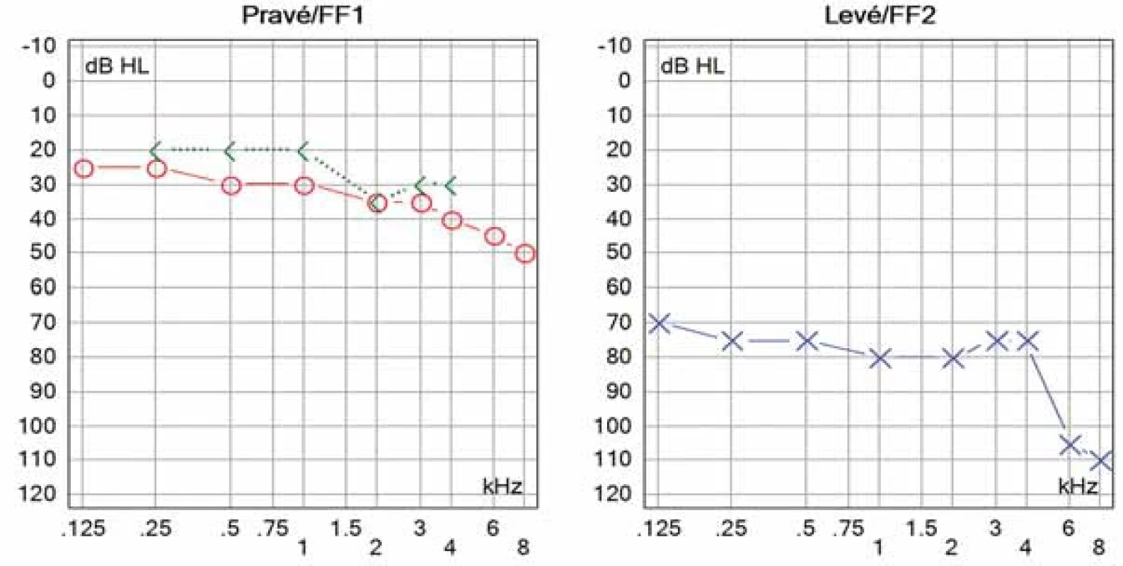 Vstupní prahový tónový audiogram – těžká percepční nedoslýchavost vlevo.