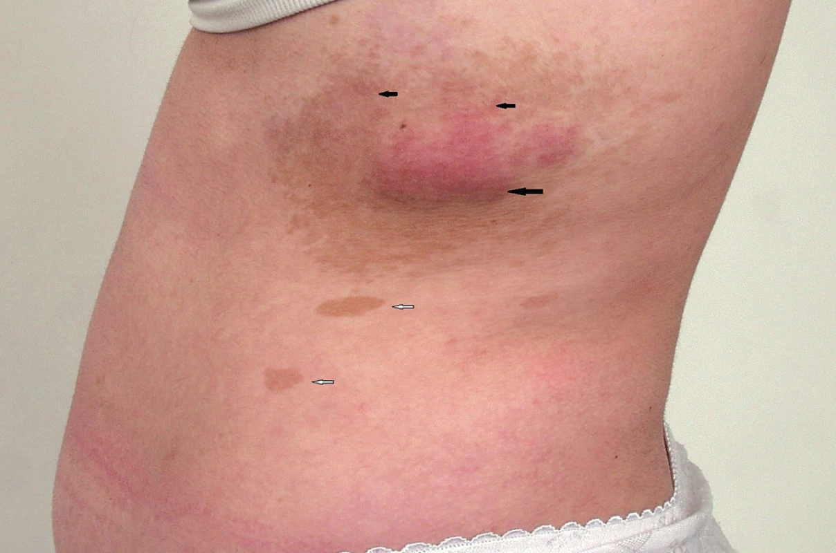 Plexiformní neurofibrom na stěně hrudníku (velká černá šipka) se známkami infiltrativního šíření do okolí (malé černé šipky) a s hyperpigmentací v okolí neurofibromu. Skvrny barvy bílé kávy (skvrny café au lait) na kůži (bílé šipky).