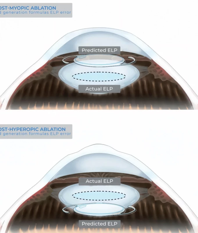 After myopic ablation, since the anterior curvature is flattened, third-generation biometric formulas (SRK/T, Hoffer Q and Holladay I) will erroneously predict a too-shallow postoperative anterior chamber depth, and therefore an excessively anterior effective intraocular lens position (top), and, conversely, after hyperopic ablation, they will wrongly predict an excessively posterior effective intraocular lens position (bottom)