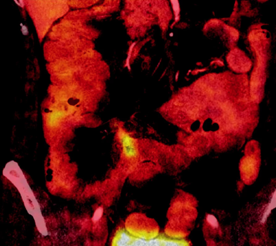 PET/CT 05/2007
Obr. 2. PET/CT 05/2007
Změny v pravé polovině mezenteria jsou nejspíše reakcí na předchozí operační výkon a komplikované hojení střevní anastomózy.