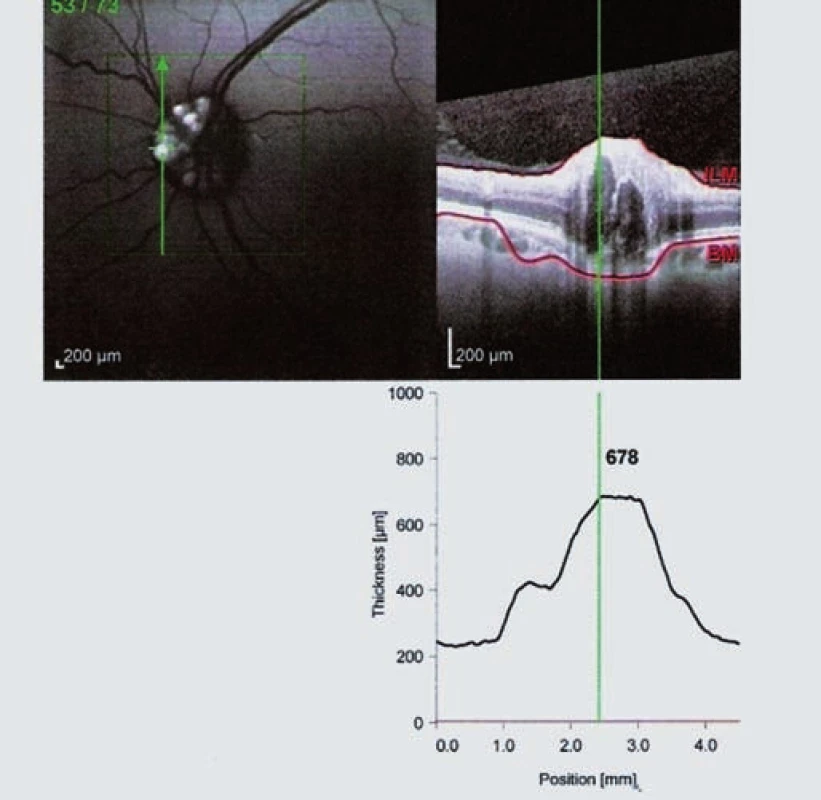 OCT Spectralis – fundus autoflorescencia ľavého oka (pacient č. 1).
Drúzy sa zobrazujú ako hyperfluorescentné útvary. V pravej časti obrázka prierez predného úseku zrakového nervu OCT.