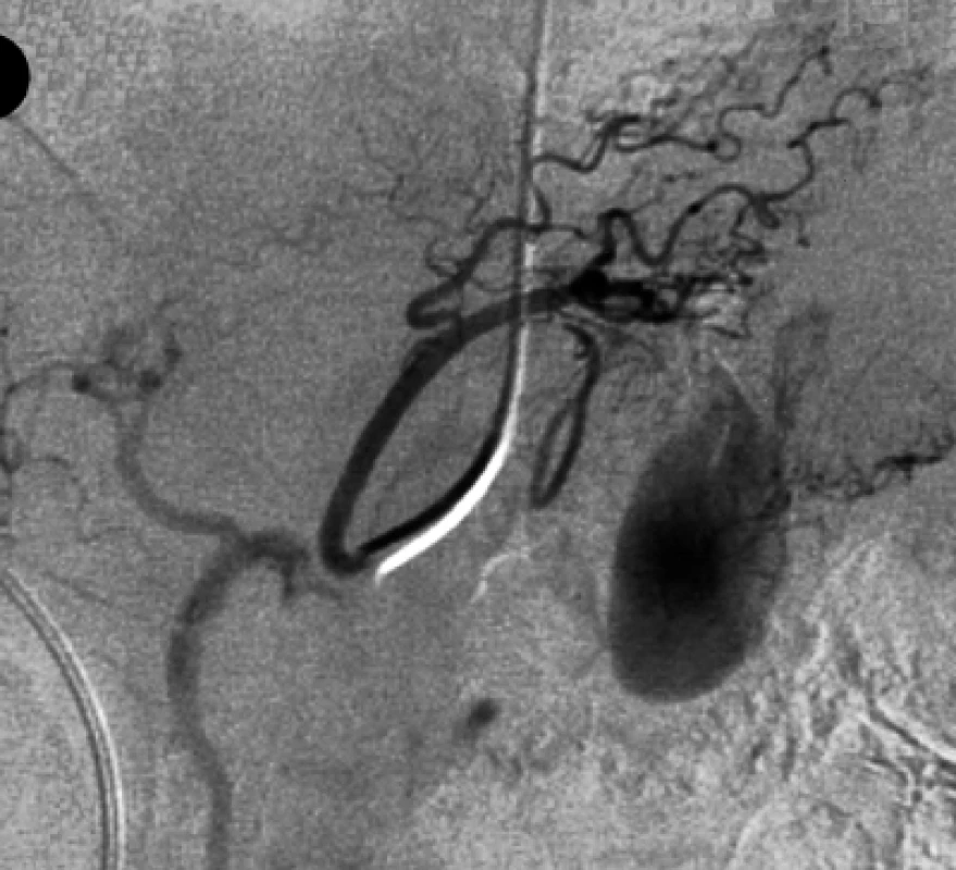 Při selektivní angiografii levé gastrické tepny se kromě pseudoaneuryzmatu retrográdně stopou plní
také pravá gastrická tepna.