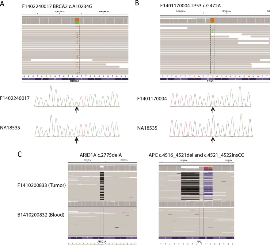 Examples of SNV and indels detected by next-generation sequencing (NGS). Sequence alignment data was viewed by Integrative Genomics Viewer (IGV) (A and B top panel, and C).The two vertical discontinued lines framed the aligned bases at the variant site. A coverage track as a gray bar chart for each locus was shown on top of the alignment track. If a nucleotide differs from the reference sequence in greater than 10% of quality-weighted reads, Integrative Genomics ViewerIGV colors the bar in proportion to the read count of each base. In alignment track, read bases that match to the reference sequence are displayed in gray. Read bases that do not match the reference are labeled and color coded. Base color code: green for A; blue for C; orange for G; red for T). RefSeq Gene track was shown at the bottom. Sanger sequencing validation for SNVs in the tumor sample and normal control NA18353 DNA were shown at the bottom in A and B. Black arrow indicated the mutant site tested.