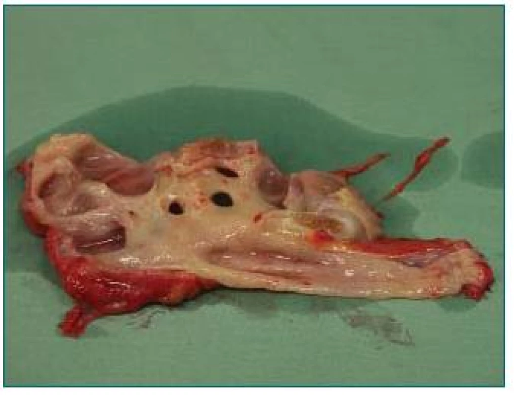 Ledvina zaniklá refluxem a odstraněná před transplantací jako zdroj infekce.
