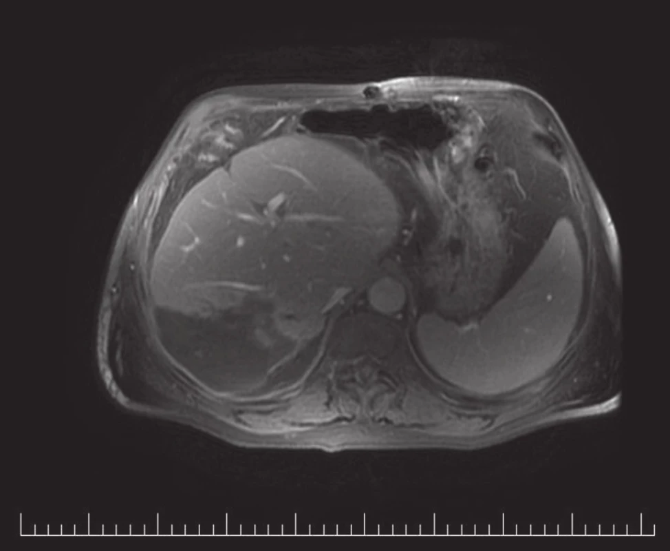 MRI: pooperační bilom
Fig. 2. MRI: Postoperative biloma