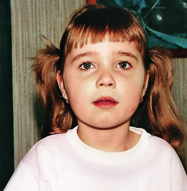 Dívka s Rettovým syndromem 5 let, období progrese epileptických paroxysmů.
