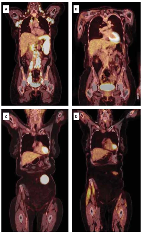 Série PET/CT vyšetření při diagnóze (A), při dosažení první kompletní remise (B), v relapsu (C) a po terapii dvěma cykly tafasitamab-lenalidomid (D).