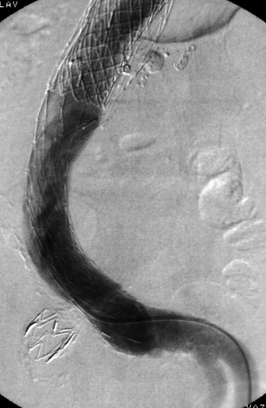 Poslední angiografie nově s rozvojem distálního endoleaku Ib ze společné iliacké tepny vlevo
Fig. 5. Last angiography with recent development of distal endoleak Ib from left common iliac artery