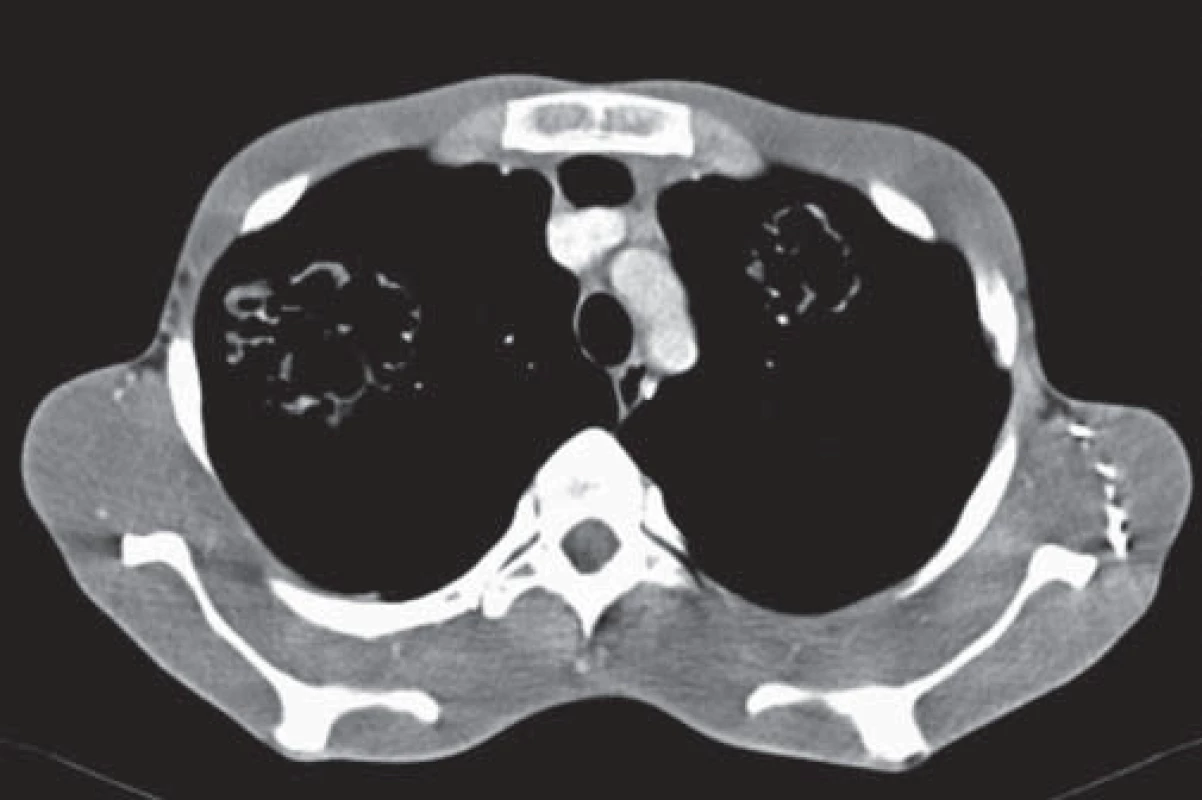 CT pľúc, 2014 – viditené bilaterálne parazitárne ložiská lamelárnej štruktúry.
Fig. 2. CT of the lungs, 2014 – visible bilateral parasitic foci of lamellar structure.